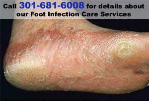 Foot Surgery - Silver Spring, MD  - Janice Postal DPM - Call 301-681-6008 for details about our Foot Infection Care Services
